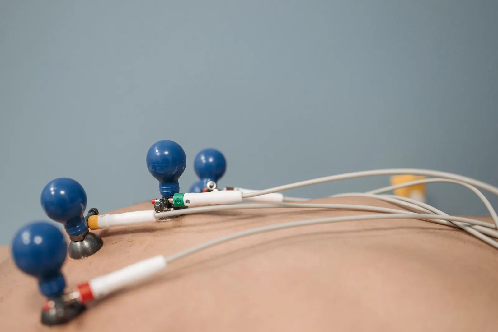 ECG electrodes attached to a patient's chest